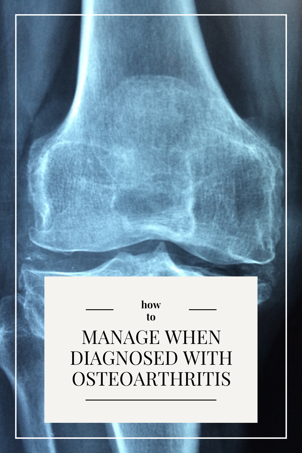 How to Manage Your Lifestyle When Diagnosed with Osteoarthritis - I do ...